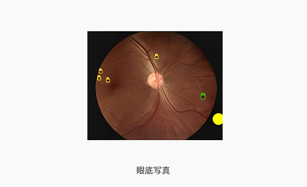眼底写真